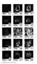 Fig. 02 - Method for treating kidney disease with a SLIT2-binding extracellular domain of ROBO2