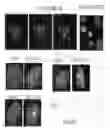 Fig. 76 - Method for the detection of cancer cells by localization of peptides in nucleus as compared to cytoplasm