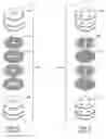 Fig. 05 - MLCC filter on an AIMD circuit board having an external ground plate adjacent to the hermetic seal insulator