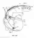 Fig. 75 - MLCC filter on an AIMD circuit board having an external ground plate adjacent to the hermetic seal insulator