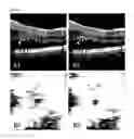 Fig. 06 - Systems and methods for retinal layer segmentation in OCT imaging and OCT angiography