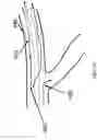 Fig. 11 - SYSTEMS AND METHODS FOR QUANTIFYING CONDUCTANCE IN THE VASCULATURE
