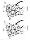 Fig. 18 - SYSTEMS AND METHODS FOR QUANTIFYING CONDUCTANCE IN THE VASCULATURE