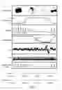 Fig. 12 - Systems, methods and devices for diagnosing sleep apnea