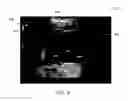 Fig. 09 - METHODS AND SYSTEMS FOR A VELOCITY THRESHOLD ULTRASOUND IMAGE