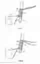 Fig. 09 - Fixation devices methods and systems for soft tissue repair