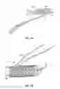 Fig. 11 - Fixation devices methods and systems for soft tissue repair