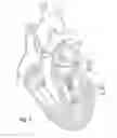 Fig. 12 - Suture and method for repairing a heart