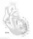 Fig. 13 - Suture and method for repairing a heart