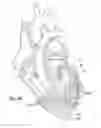 Fig. 15 - Suture and method for repairing a heart