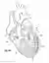Fig. 16 - Suture and method for repairing a heart