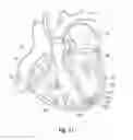 Fig. 20 - Suture and method for repairing a heart