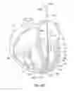 Fig. 23 - Suture and method for repairing a heart