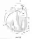 Fig. 24 - Suture and method for repairing a heart