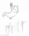 Fig. 33 - Endoscopic suture loop anchors and methods