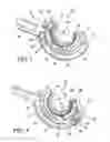 Fig. 03 - Method for suture lacing