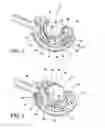 Fig. 04 - Method for suture lacing