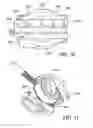 Fig. 14 - Method for suture lacing