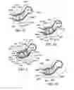 Fig. 25 - Method for suture lacing