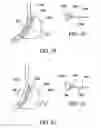 Fig. 32 - Method for suture lacing