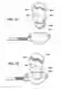 Fig. 35 - Method for suture lacing