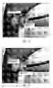 Fig. 08 - Methods and apparatus for magnet-induced compression anastomosis between adjacent organs