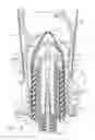 Fig. 09 - Circular surgical fastening devices with tissue acquisition arrangements