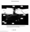 Fig. 05 - Implant devices with a pre-set pulley system