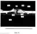 Fig. 06 - Implant devices with a pre-set pulley system