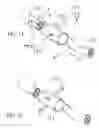 Fig. 09 - Implant devices with a pre-set pulley system