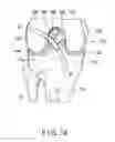 Fig. 12 - Surgical procedure of knee joint