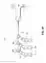 Fig. 22 - Object removal through a percutaneous suction tube