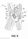 Fig. 06 - Retractable forceps