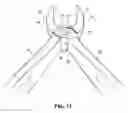 Fig. 08 - Retractable forceps