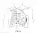 Fig. 02 - Multi-purpose medical tools and methods for gaining access to extravascular spaces in a patient