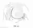 Fig. 09 - Multi-purpose medical tools and methods for gaining access to extravascular spaces in a patient