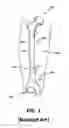 Fig. 02 - Orthopedic device for closed fracture reduction