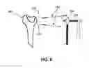 Fig. 08 - Orthopedic device for closed fracture reduction