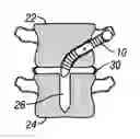 Fig. 01 - Distraction screw