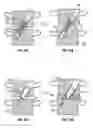 Fig. 08 - Distraction screw