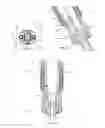 Fig. 07 - Instruments and methods for adjusting separation distance of vertebral bodies with a minimally invasive spinal stabilization procedure