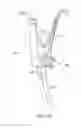 Fig. 17 - Instruments and methods for adjusting separation distance of vertebral bodies with a minimally invasive spinal stabilization procedure