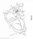 Fig. 07 - System and method for treating arrhythmias in the heart using information obtained from heart wall motion