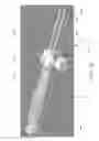 Fig. 06 - Devices and methods for fistula formation