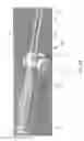 Fig. 07 - Devices and methods for fistula formation