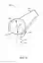 Fig. 13 - Illuminated ophthalmic cannula
