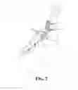 Fig. 03 - ORTHODONTIC PLATE FIXED TO MANDIBULAR RAMUS