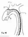Fig. 09 - Method For Delivery Of An Embolic Protection Unit