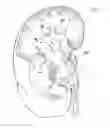Fig. 02 - DEVICE WITH A J-SHAPED END AND WITH AN INFLATABLE BALLOON FOR USE AS SUPPORT FOR DEVICES FOR TISSUE RECONSTRUCTION OF EXCISED TISSUES OF THE RENAL PELVIS AND/OR OF THE URETEROPELVIC JUNCTION