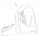 Fig. 01 - Trochlear resurfacing system and method